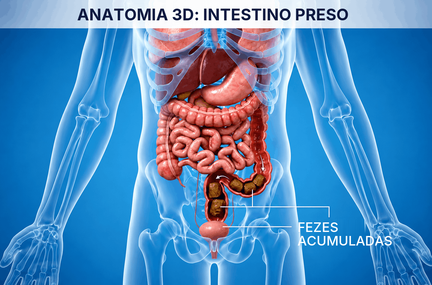 Anatomia 3D do intestino preso, com fezes acumuladas